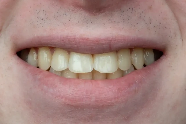 Nachher Komposit-Veneers Tunesien – ausgerichtetes und natürliches Lächeln Ergebnis VIP Smile