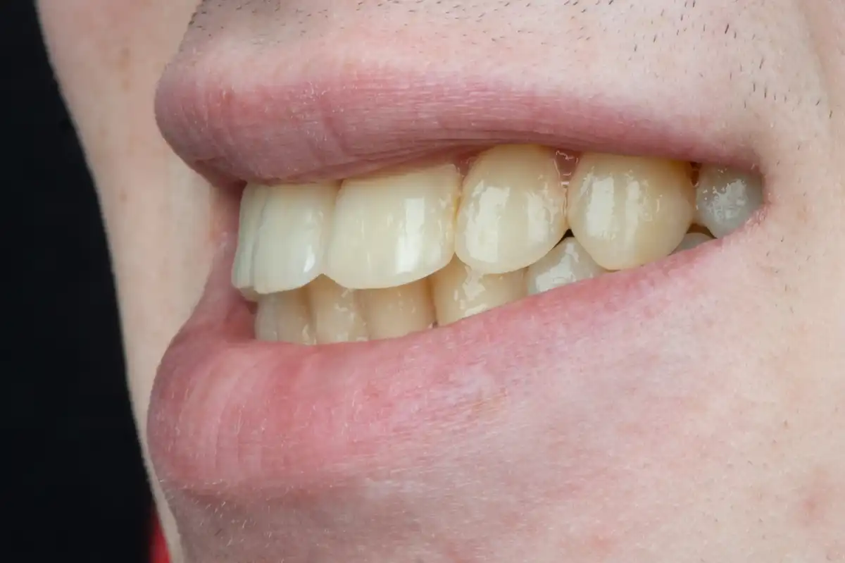 Dopo prezzo faccetta porcellana Tunisia – sorriso bianco e uniforme VIP Smile