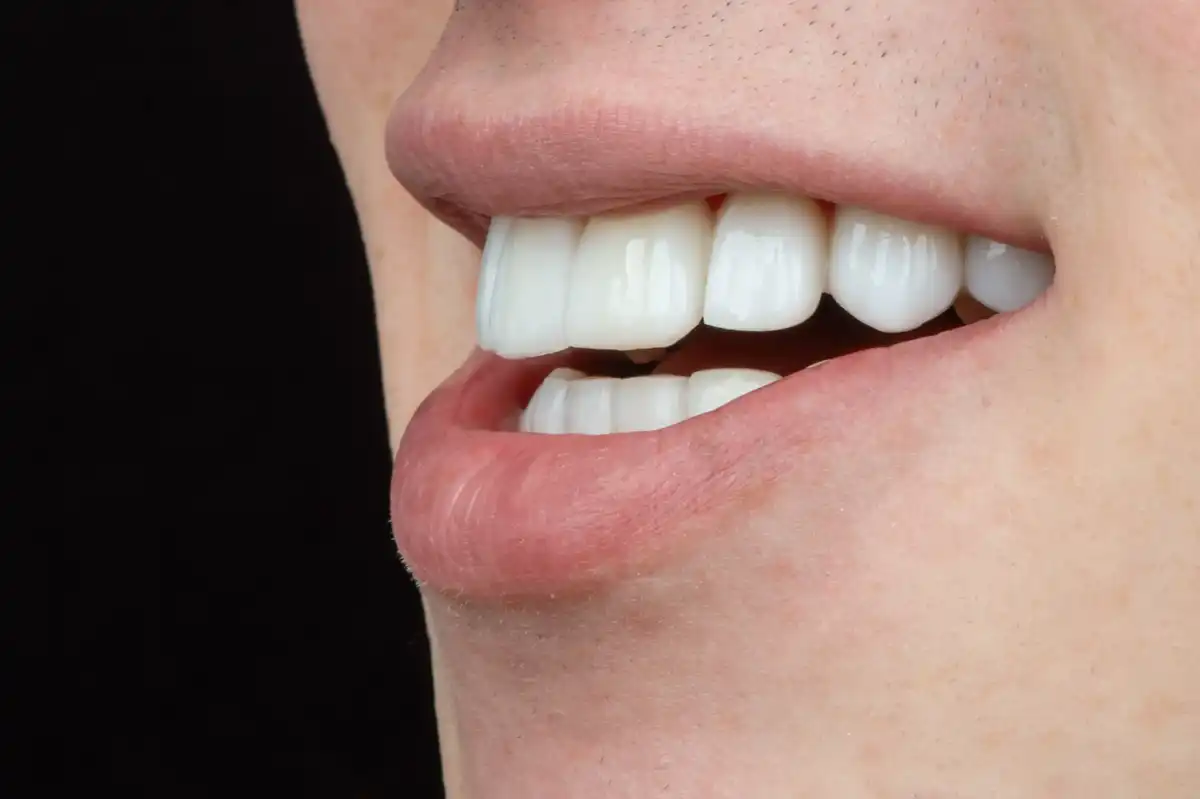 Prima prezzo faccetta porcellana Tunisia – denti macchiati e spaziati VIP Smile