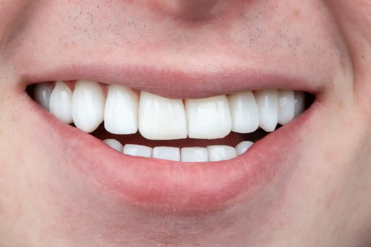 Vorher Komposit-Veneers Tunesien – unregelmäßige und erodierte Zähne Patient VIP Smile
