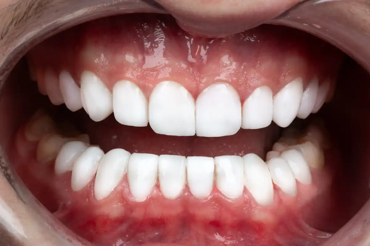 Prima faccette dentali economiche Tunisia – sorriso irregolare VIP Smile