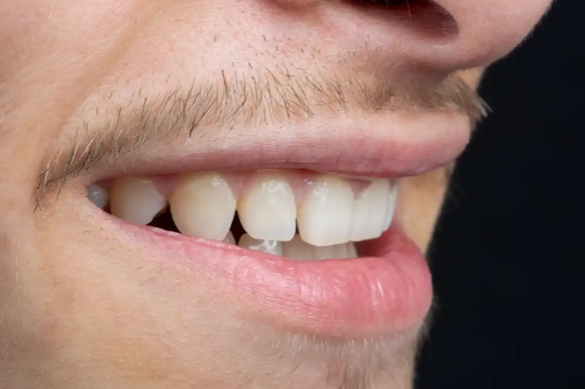 Nachher Zirkonium-Veneer Tunesien – geschützte und ästhetische Zähne Ergebnis VIP Smile