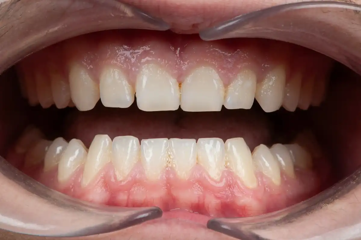 Dopo faccette dentali Tunisia – risultato 12 faccette VIP Smile