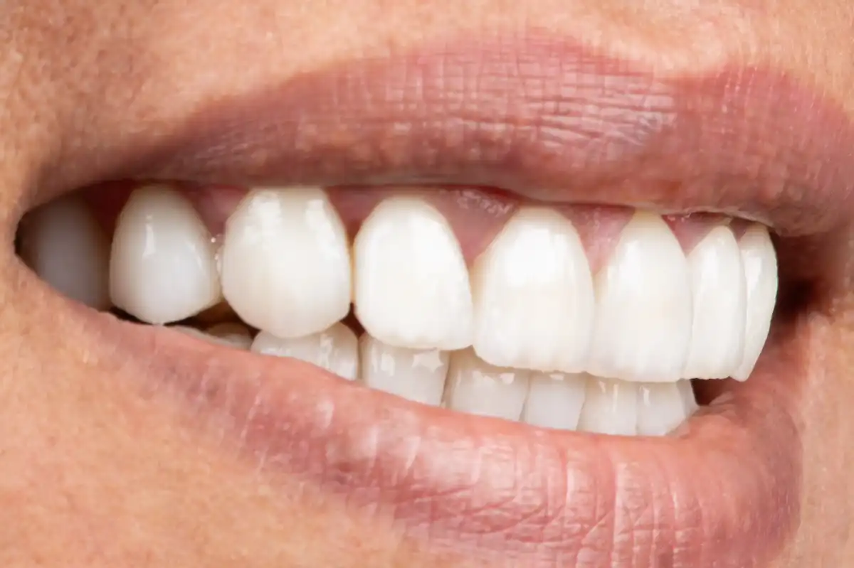 Avant All-on-4 Tunisie – arcade édentée patient 1 VIP Smile