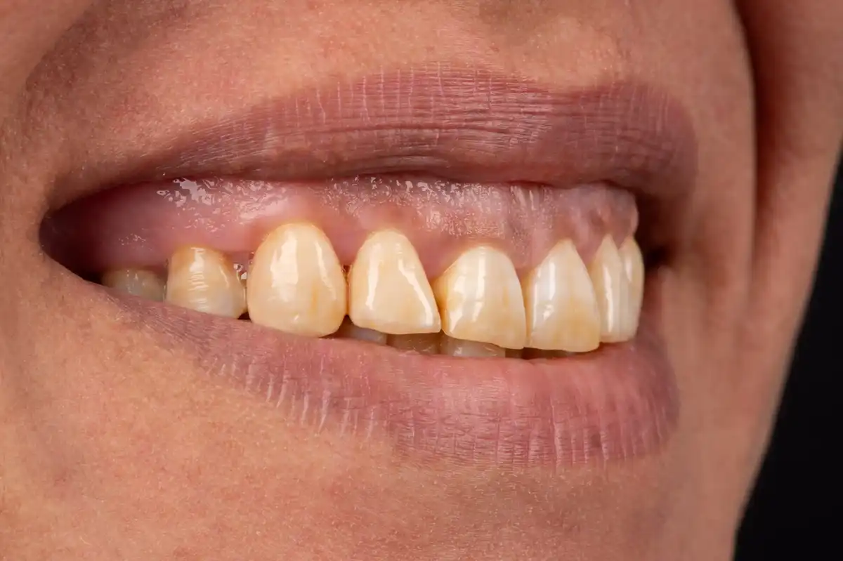 Après All-on-4 Tunisie Nobel Biocare – prothèse zircone fixe résultat VIP Smile