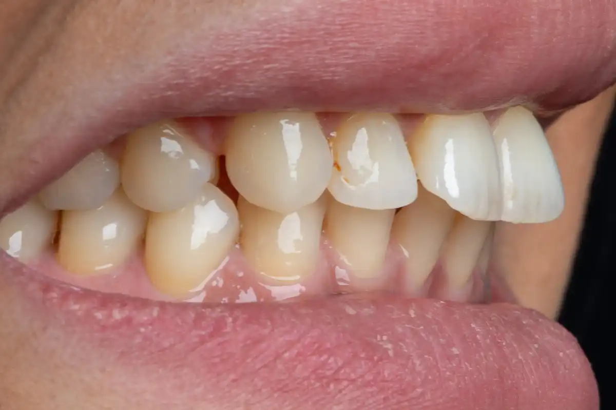 Après All-on-4 Tunisie – 2 arcades fixes résultat VIP Smile Tunis