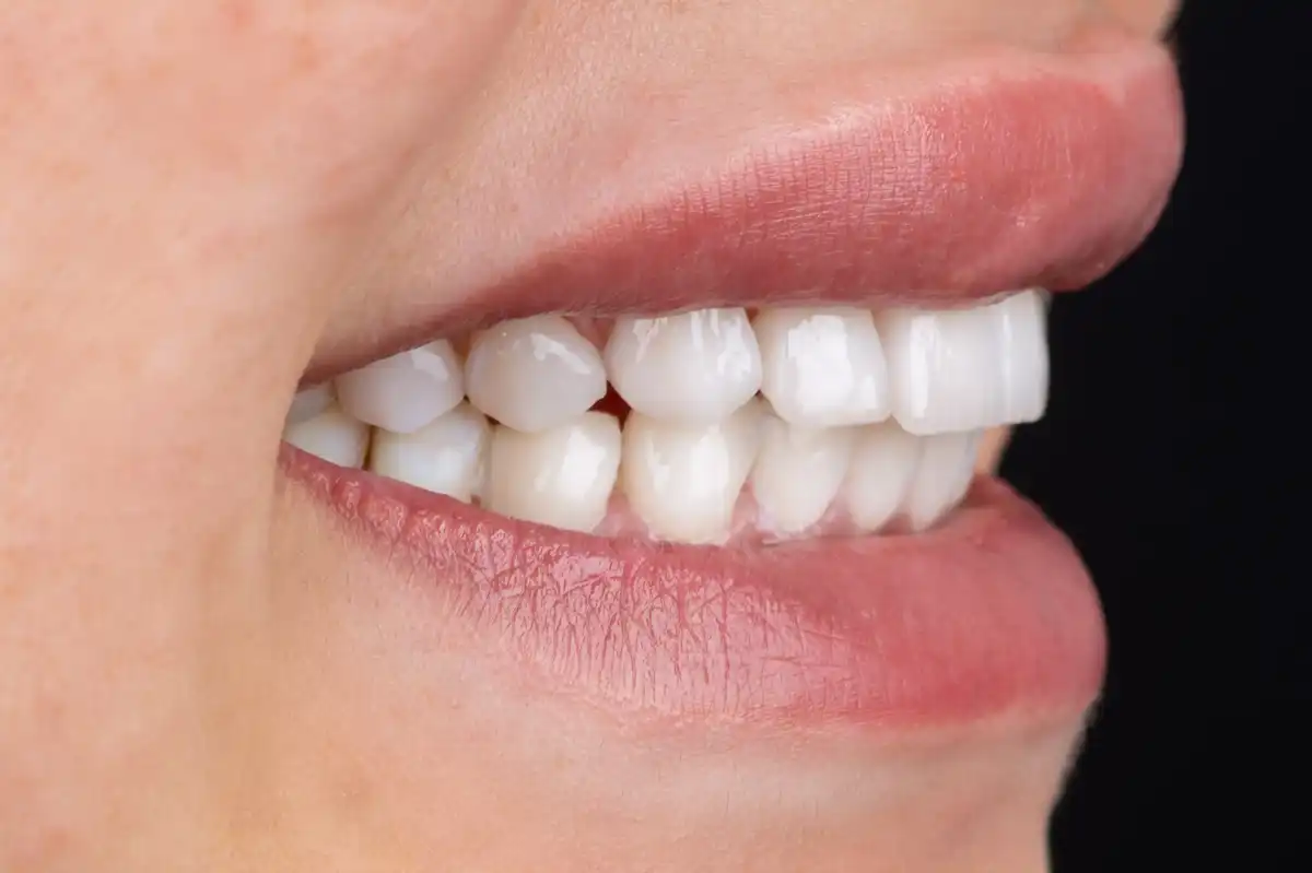 Avant All-on-4 Tunisie – prothèse amovible instable patient 2 VIP Smile