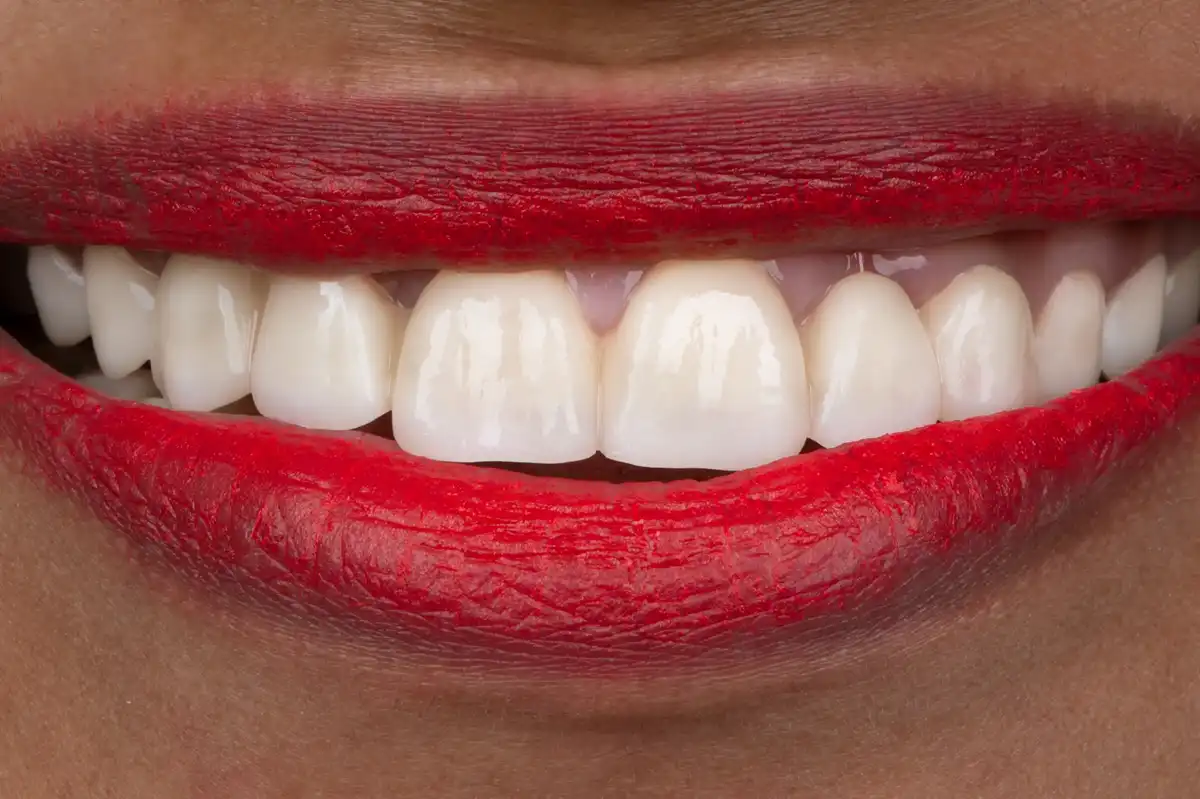 Avant All-on-4 Tunisie – parodontite avancée multiples extractions patient 3 VIP Smile