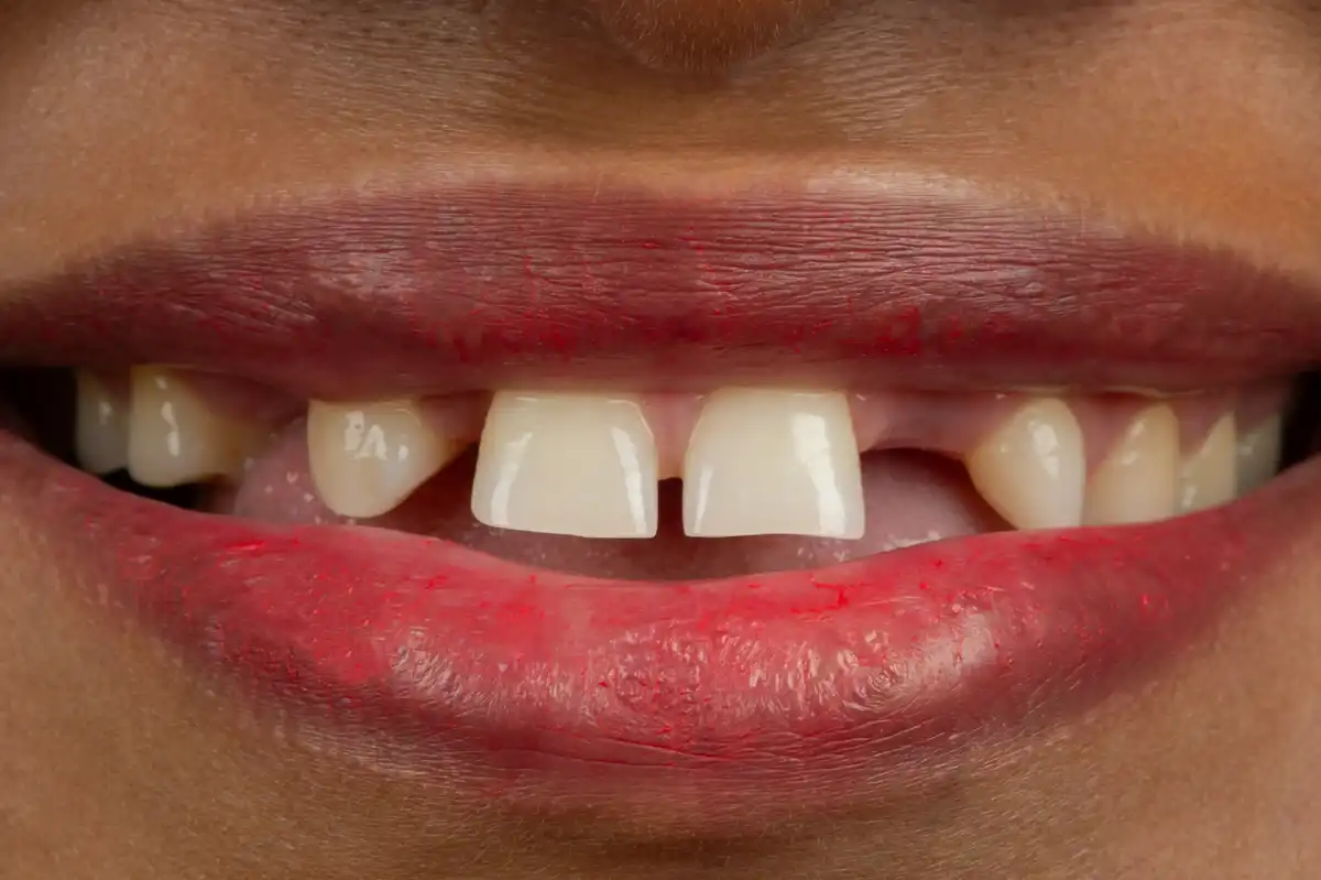 Après All-on-4 Tunisie – extraction + implants immédiats arcade mandibulaire VIP Smile